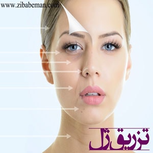 تزریق ژل
