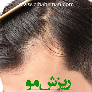 ریزش مو