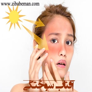 آفتاب سوختگی
