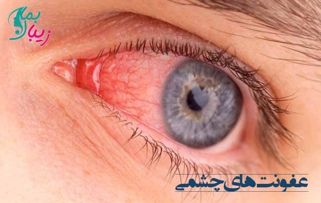 انواع عفونت چشمی
