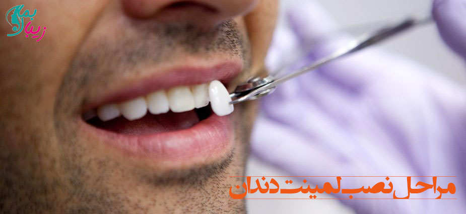 مراحل نصب لمینت دندان