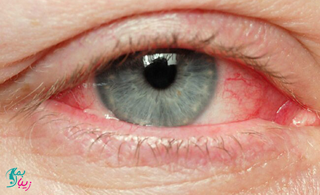 عفونت های چشمی