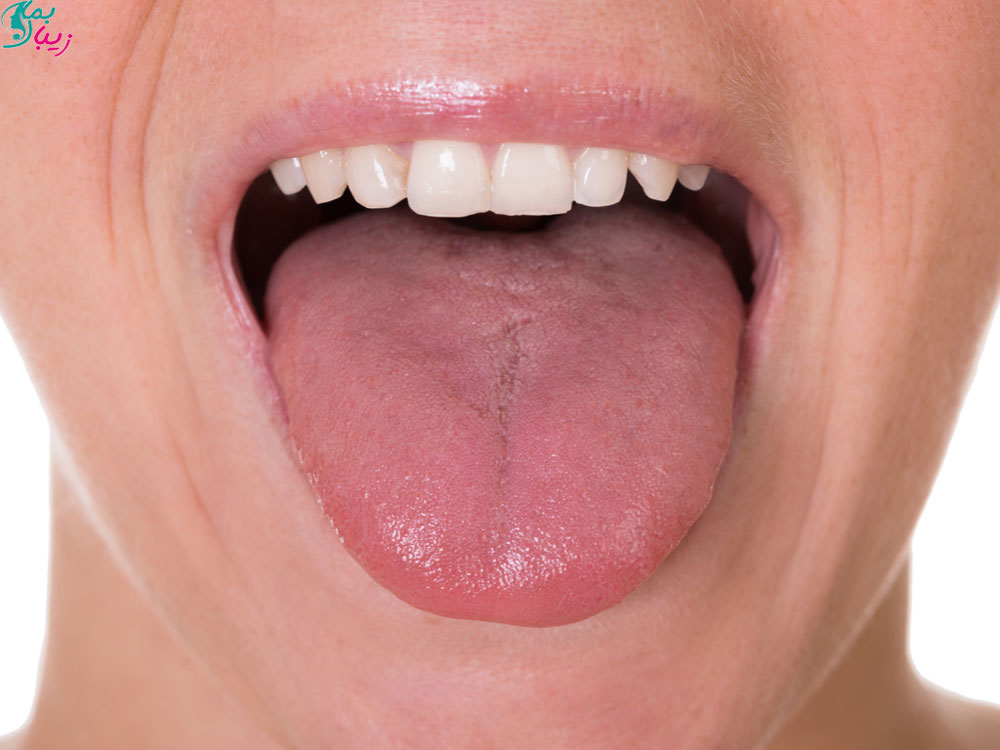داروهای زخم زبان