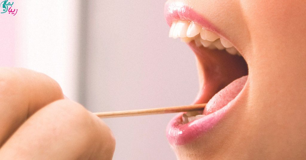 درمان سریع زخم زبان