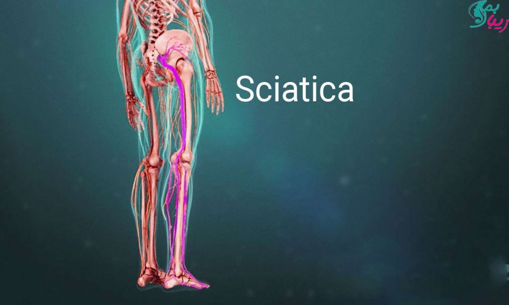 سیاتیک | درد مفصل ران و پا