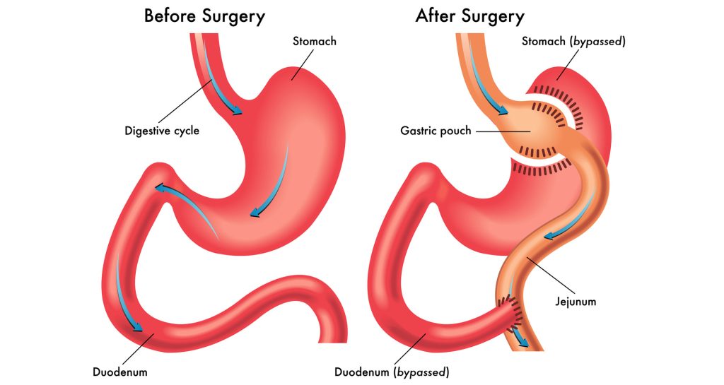 انواع جراحی معده برای لاغری