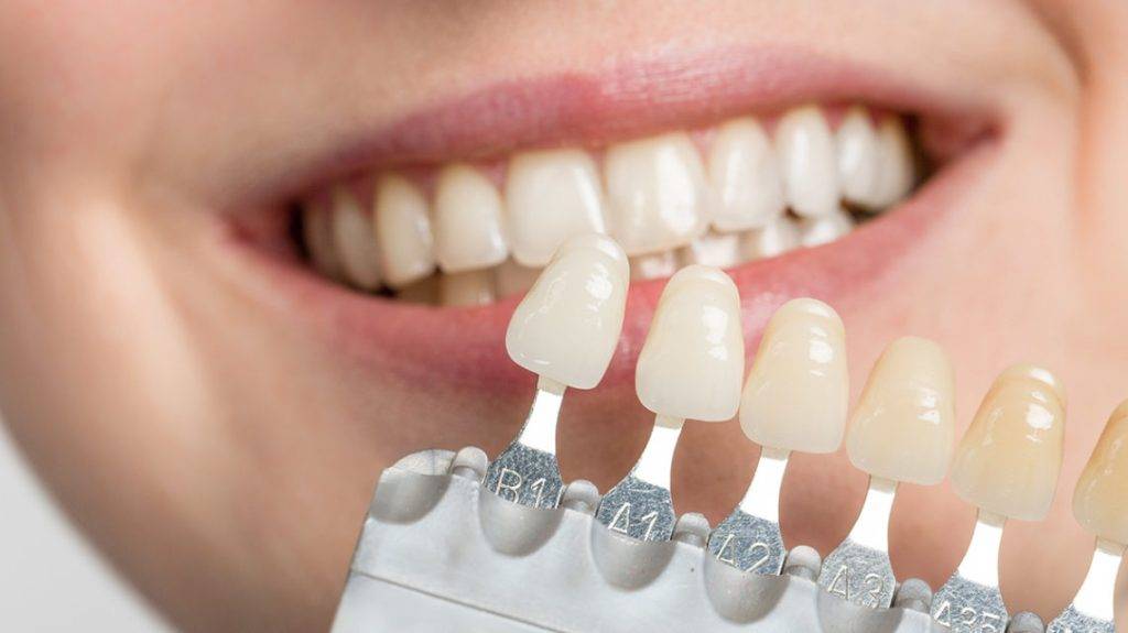 معایب روکش دندان