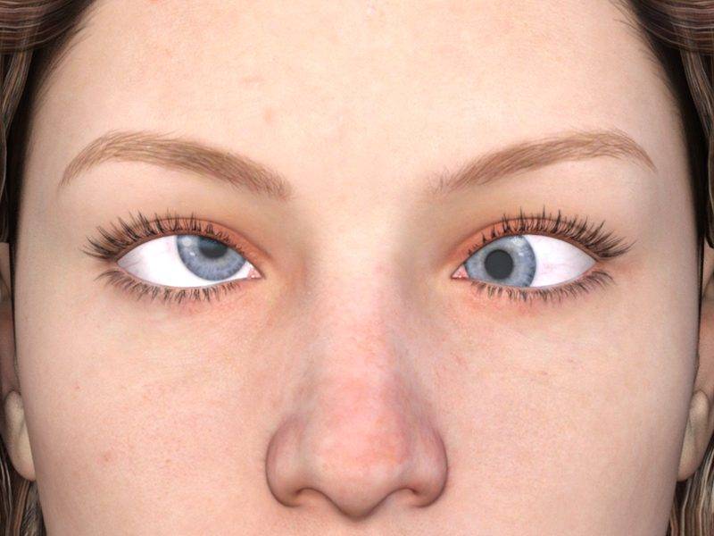 تشخیص تنبلی چشم
