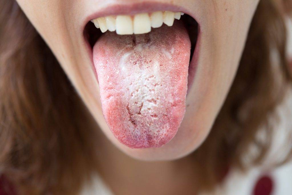 درمان برفک دهان و درمان های خانگی
