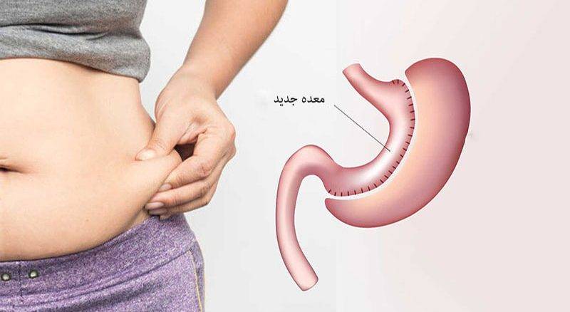 جراحی بای پس روده ( جابه جایی دوازدهه)