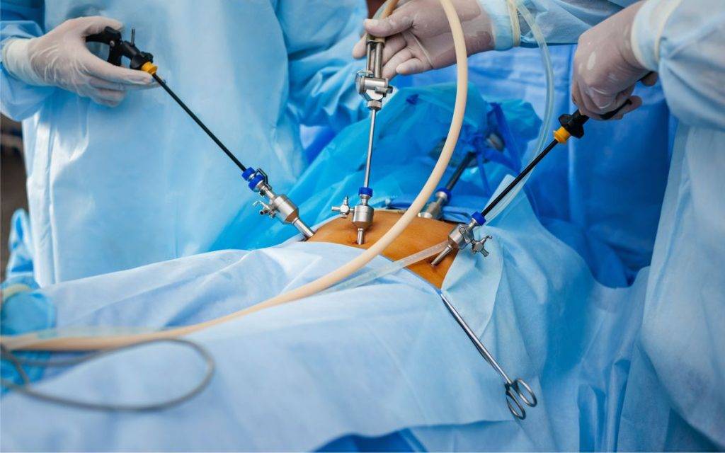 عمل لاغری لاپاراسکوپی