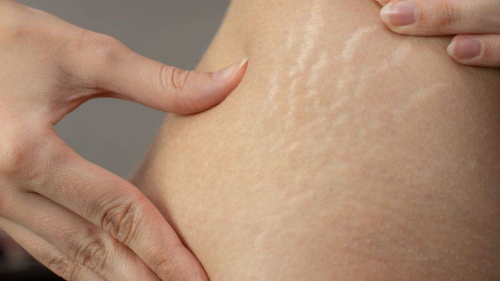 درمان ترک پوستی با روغن زیتون