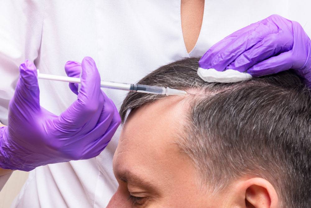 پلاکت درمانی مو چیست