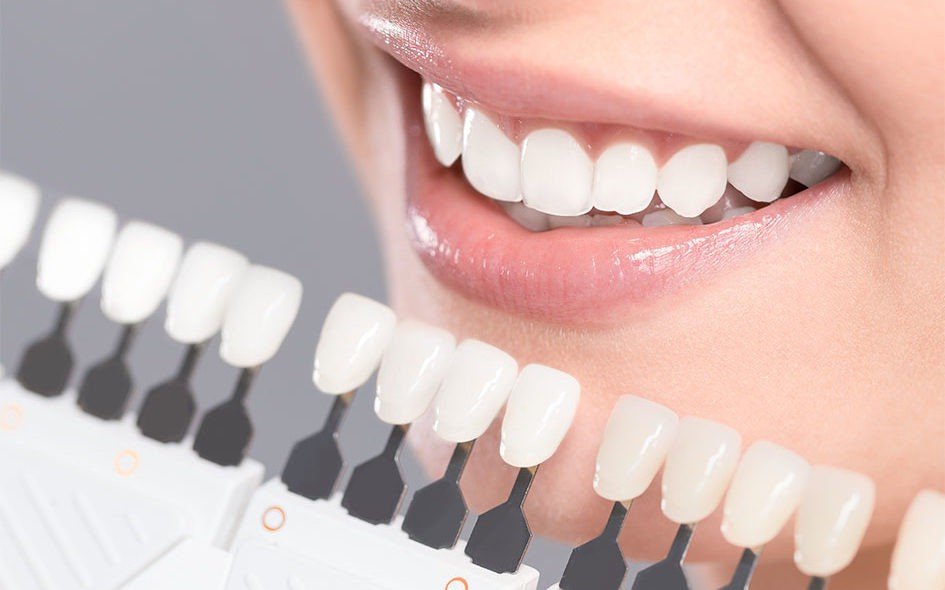 بهترین نوع کامپوزیت دندان با مناسب ترین قیمت برای خرید کدام است؟