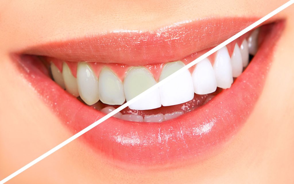 بلیچینگ دندان چیست؟
