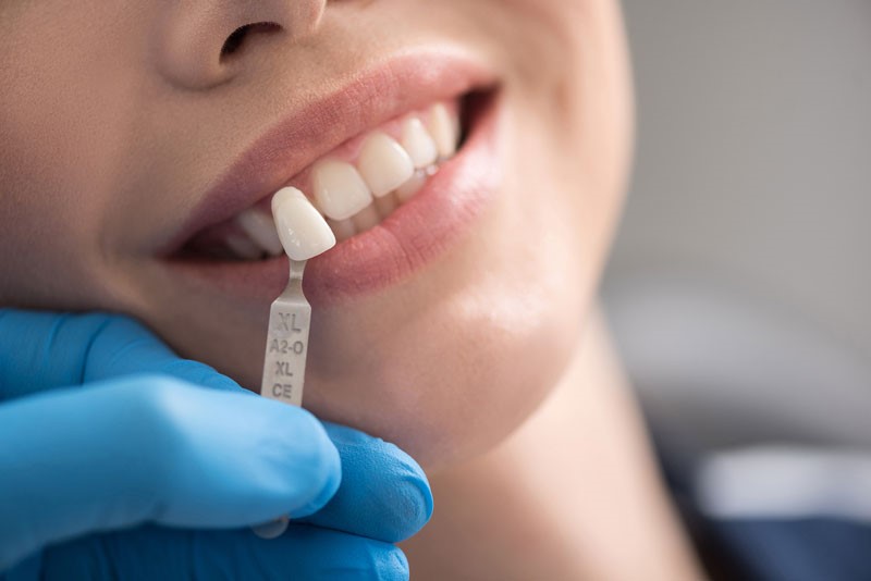 انواع خدمات کامپوزیت دندان در دکترتو کلینیک