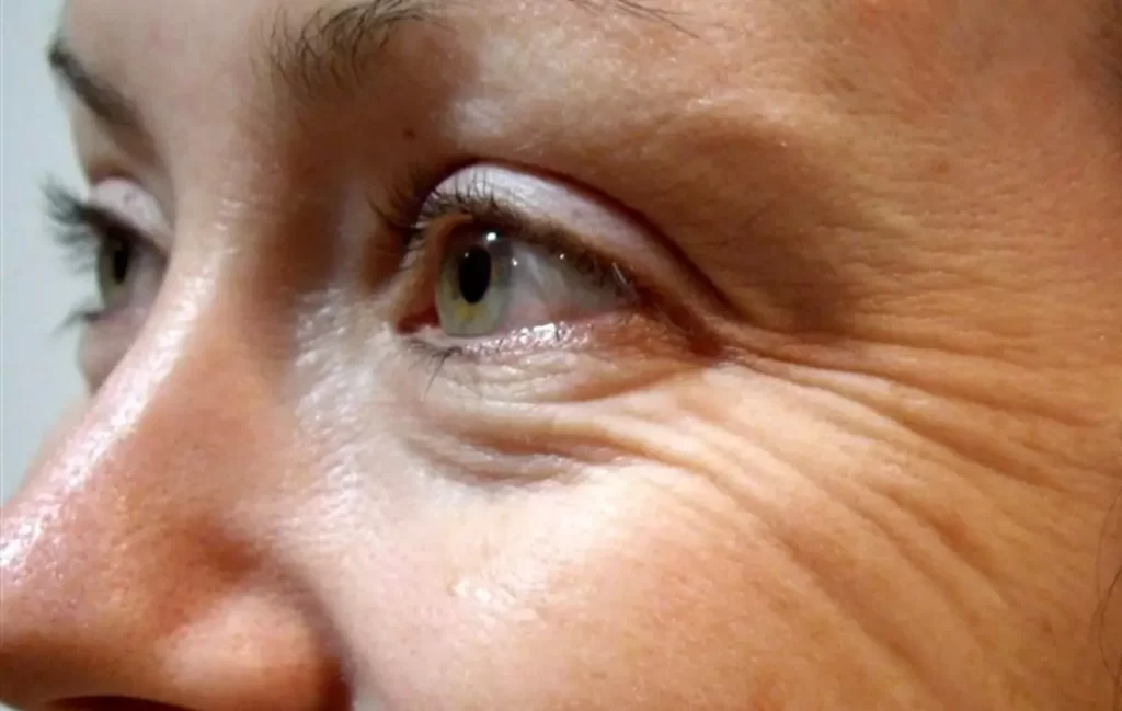 رفع خطوط دور چشم