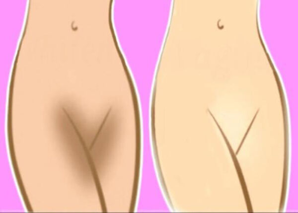 رفع تیرگی واژن