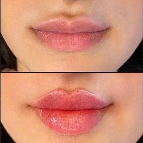 تزریق ژل لب در کرج