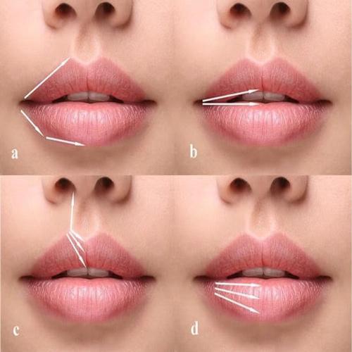 تزریق ژل لب در کرج