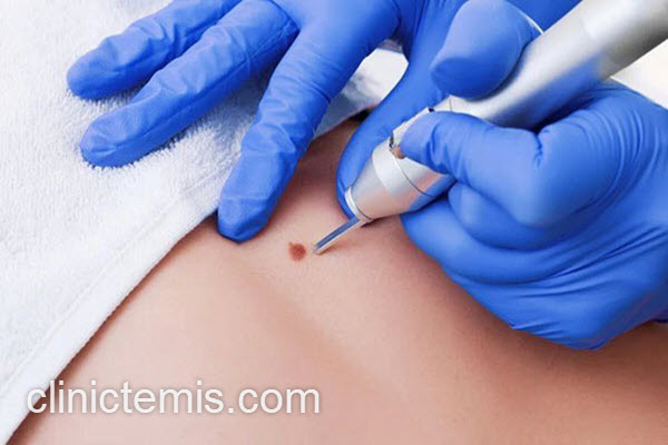 برداشتن خال مادرزادی