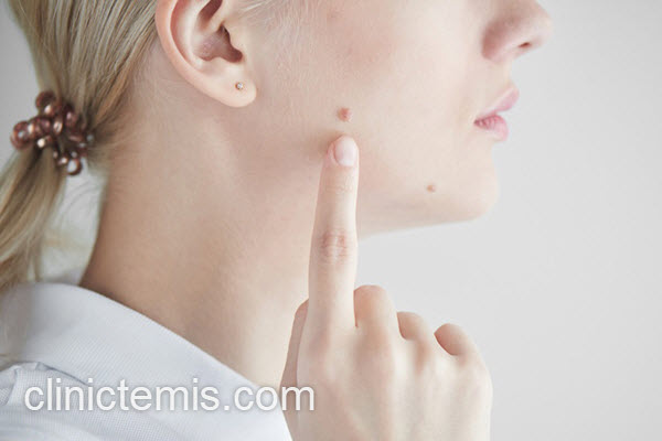 برداشتن خال مادرزادی