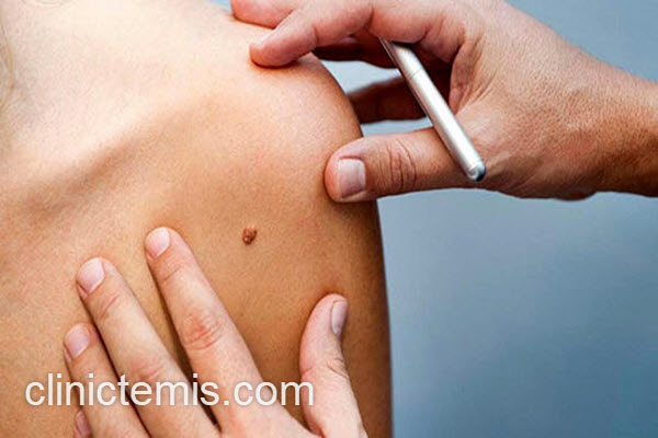 برداشتن خال مادرزادی