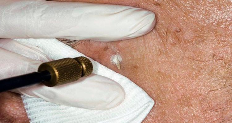 درمان زگیل تناسلی