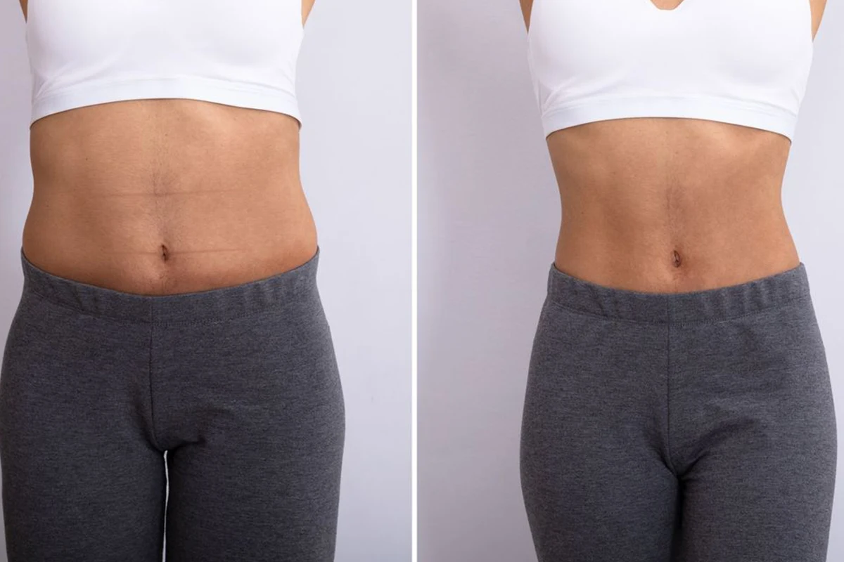 عکس نمونه قبل و بعد عمل پیکرتراشی