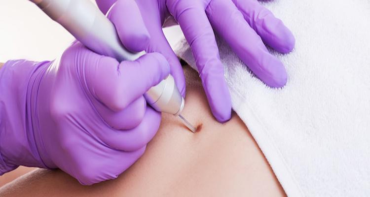 درمان زگیل تناسلی