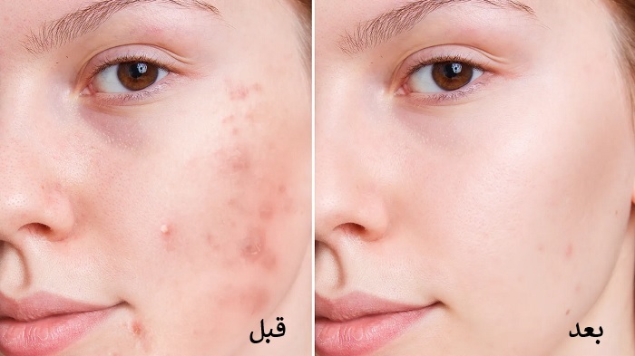 تزریق بوتاکس جای جوش