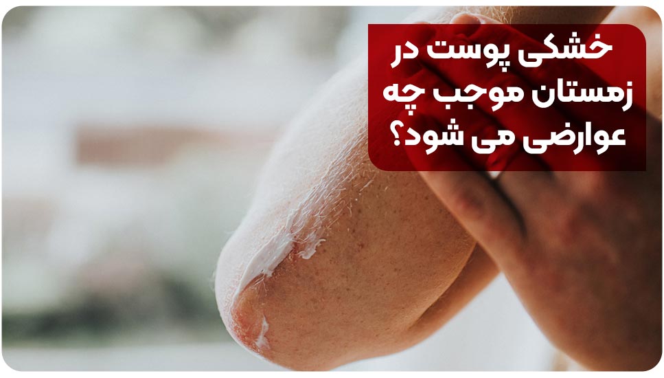 خشکی پوست در زمستان موجب چه عوارضی میشود؟