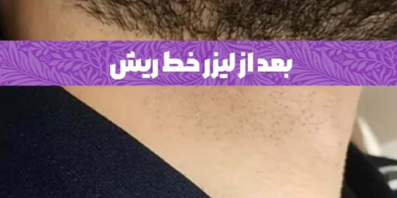 خدمات لیزر در کلینیک دسپینا