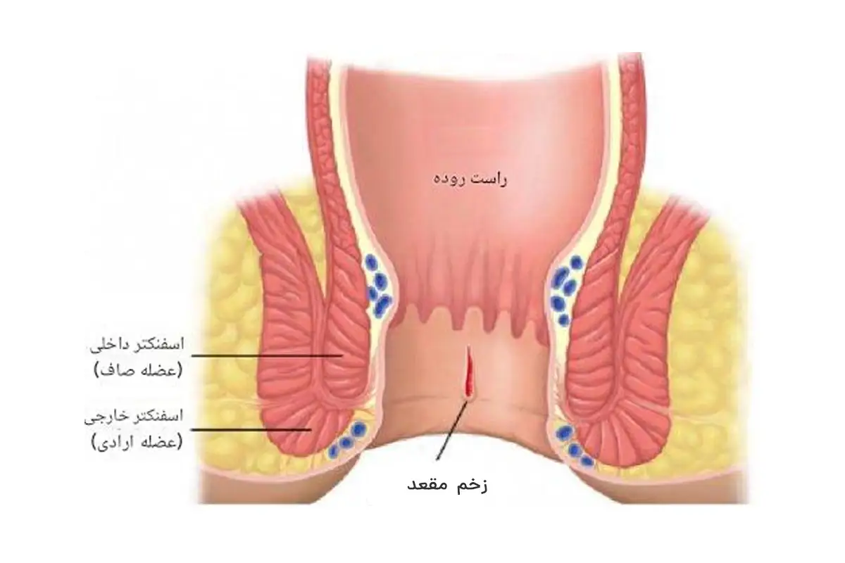 زخم مقعد