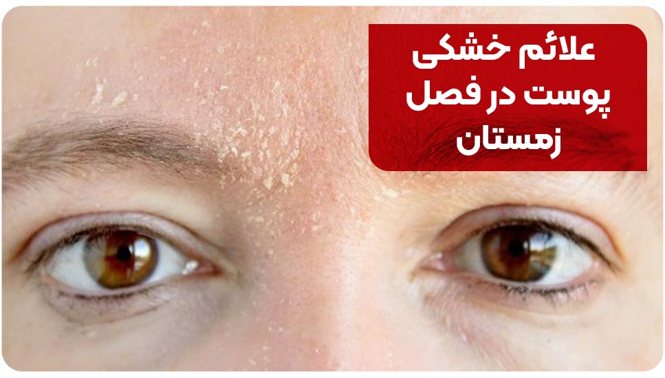 علائم خشکی پوست در فصل زمستان