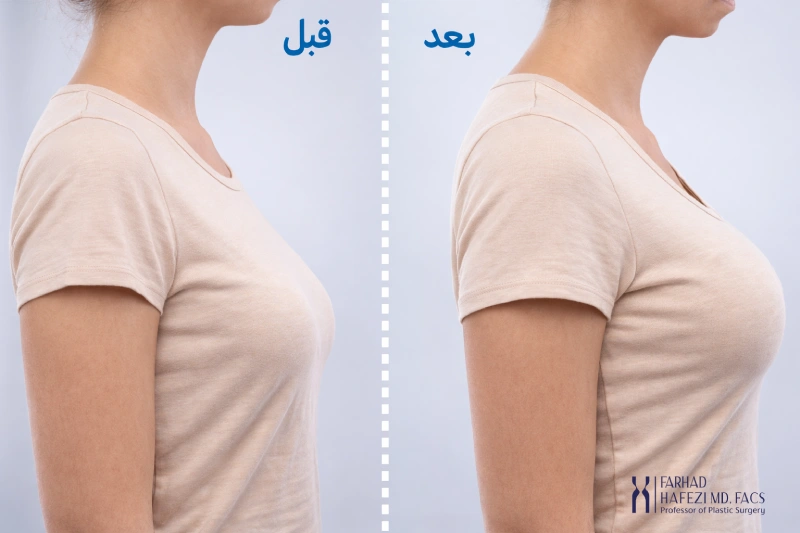 عکس قبل و بعد جراحی پروتز سینه