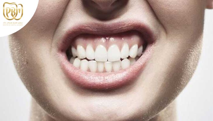 آیا بهترین روش های درمان دندان قروچه را می دانید؟