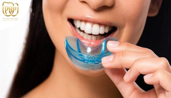 استفاده از نایت گارد برای دندان قروچه