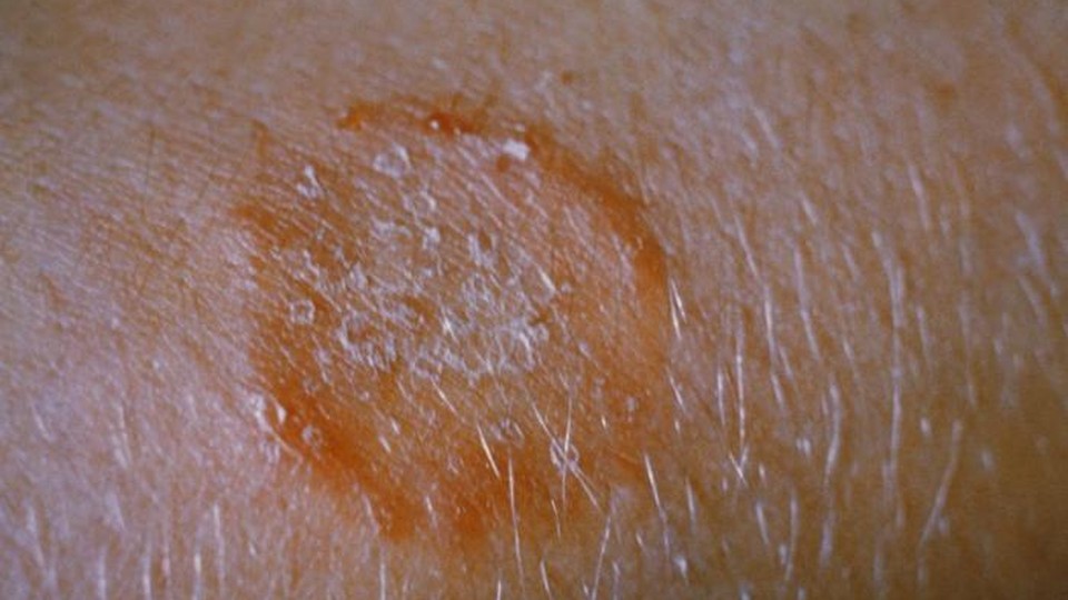 عکس واقعی قارچ بدن (تینهآ کورپوریس) با حاشیه برجسته حلقهمانند - منبع: CDC