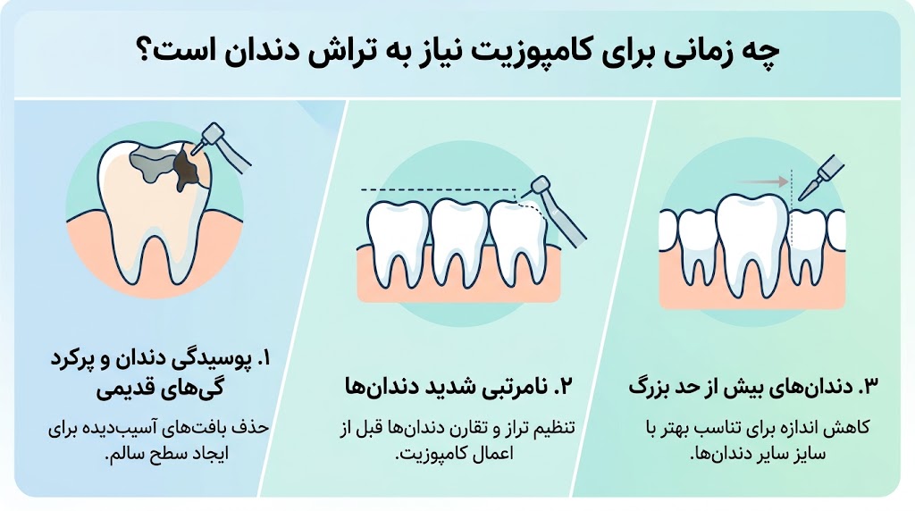 در چه شرایطی تراش دندان برای کامپوزیت الزامی است؟
