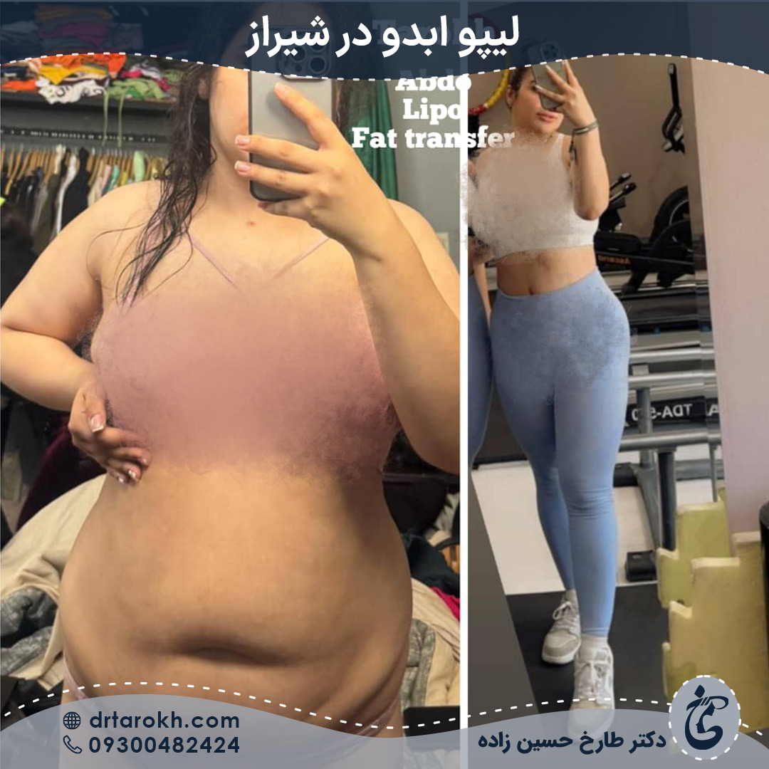 لیپو ابدو در شیراز - تصویر قبل و بعد از عمل شکم